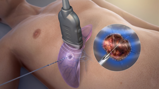 Understanding Radiofrequency Ablation (RFA) for Chronic Pain