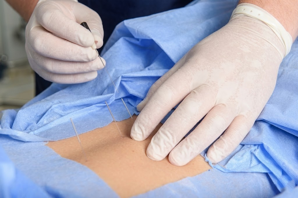 Epidural Injection Treatment