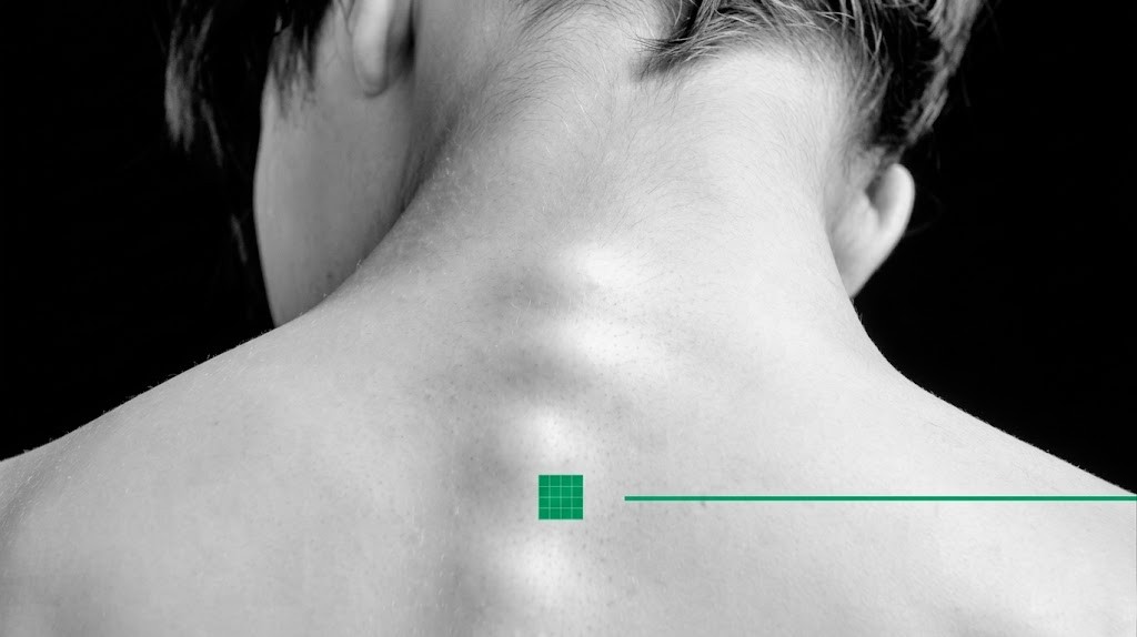 Radiculopathy Treatment